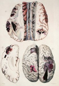 Kapilární apoplexie, z „Anatomie Pathologique du Corps Humain“ od Jean Cruveilhier (1791-1874) 1828-42 (barevná rytina)