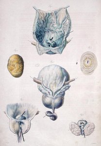 Nemoci močového měchýře a prostaty, z „Anatomie Pathologique du Corps Humain“ od Jean Cruveilhier (1791-1874) 1828-42 (barevná rytina)