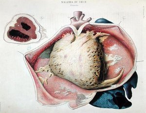 Perikarditida, deska zobrazující srdeční choroby z „Anatomie pathologique du corps humaine“ od Jeana Cruveilhiera (1791-1874), vydaného v Paříži