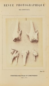 Mnohočetné symetrické exostózy, femur, tibie od Arthur de Montmeja