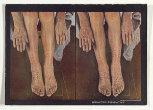 Dermatitis exfoliativa od Dr. Selden I. Rainforth