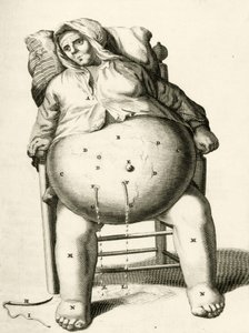 Vypouštění tekutin z abscesu Frederik Dekkers, 1694 od Dutch School