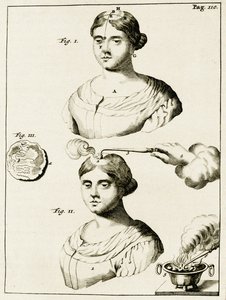 Léčba pacienta trpícího epilepsií z cvičení v lékařské praxi Frederik Dekkers, 1694 od Dutch School