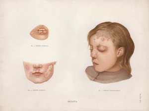 Kožní onemocnění: Herpes (barevné lito) od English School