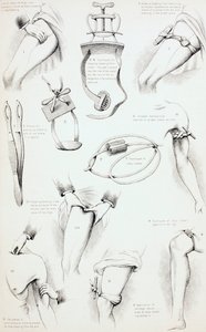 Metody zatčení krvácení, c.1890 od English School