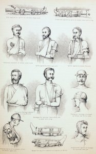 Dočasná léčba zlomenin, c.1890 od English School