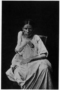 Fotografie pacienta trpícího hemiplegickou epilepsií, -in "" fotografická ikonografie Salpetrière, Bourneville a P. Regnard, Paříž od French Photographer