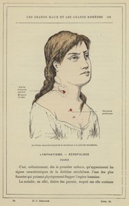 Charakteristické příhody skrofulózy v sekundárním období (barevné lito) od French School