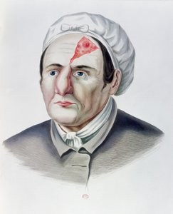 Po operaci kožního štěpu z Selecta Praxis Medico-Chirurgica od Alexandra Auverta, Paříž, 1856 od French School