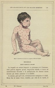 Vzhled a distribuce skvrn po spalničkách na začátku erupce (barevné lito) od French School