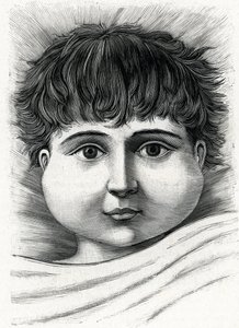 Dítě s nemocí příušnic (rytina) 1888 od French School