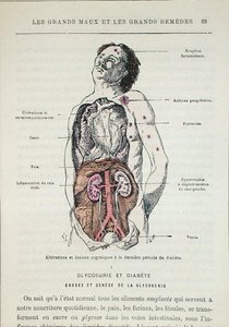 Účinky diabetu, z „Les Grands Meaux et les Grands Remedes“ od Dr. J. Rengade, Paříž od French School