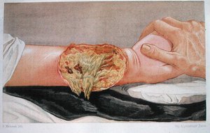 Hospital Gangrene, z 