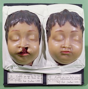 Model zobrazující dětský obličej před a po operaci korekce zaječího rtu, kterou provedl Antoine Dubois (1756-1837) v roce 1799 (vosk) od French School