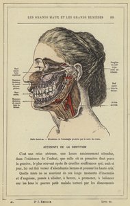 Zubní nervy, Mechanismus odontalgie produkovaný zubním kazem (barevné lito) od French School