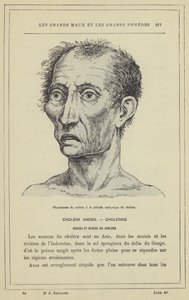 Fyziognomie pacienta během asfyxického období cholery (barevné lito) od French School