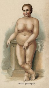 Portrét ženy s patologickou obezitou (tisk) od French School