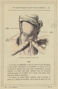 Poloha lancety v krvácení z paže (barva lito) od French School
