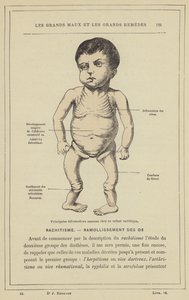 Deformace hlavní kosti u dítěte s křivicí (barva lito) od French School