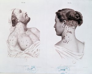 Příznaky syfilis u mužů a žen, z lékařské knihy, c.1850-60 od French School