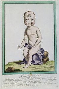 Dítě s deformovanou hlavou, z „Les Ecarts de la Nature“, Paříž, 1775