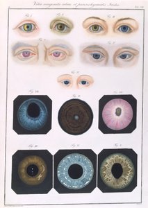 Popis vrozených očních anomálií, z Klinických popisů nemocí a zrakových vad lidského oka, Friedrich August von Ammon (1799-1861) 1838 od German School