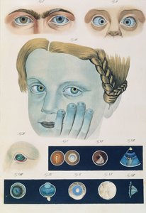 Popis vrozených očních anomálií, z Klinické reprezentace nemocí a zrakových vad lidského oka, Friedrich August von Ammon (1799-1861) 1838 od German School