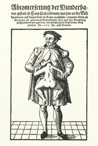 Hans Kaltenbrunn a jeho nevyvinuté siamské dvojče (rytina) od German School