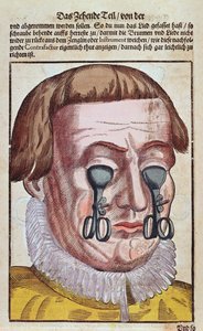 Léčba očního onemocnění, z Ophthalmodouleia od Georga Bartische (1535-1636) vydaného v Drážďanech v roce 1583 (barevný dřevořez) od German School