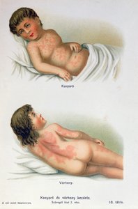 Spalničky a šarla, z rodinné lékařské knihy, kolem roku 1900 od Hungarian School