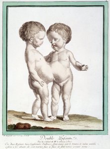 Siamské děti - v „“Odchylky přírody““ od Régnaulta od Jean Baptiste Regnault