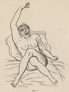 Hysterická epilepsie, záchvat, zkroucení, obr. 1 z „Iconographie Photographique de La Salpetriere“ od Bourneville et P. Regnard, Paříž, 1876
