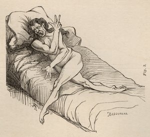 Hysterická epilepsie, záchvat, zkroucení, obr. 3 z „Iconographie Photographique de La Salpetriere“ od Bourneville et P. Regnard, Paříž, 1876 od Jean Francois Badoureau