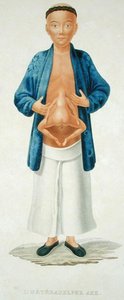 Číňan s nevyvinutým siamským dvojčetem připevněným na břiše, ilustrace z francouzského cestopisu, rytina M. Legranda (barevná rytina)