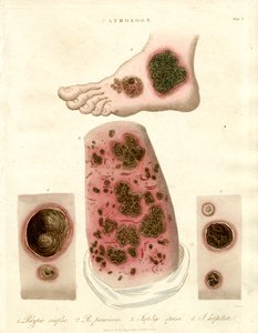 Patologické stavy kůže - Pityria;Impetigo a syfilis