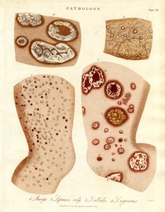 Patologické stavy kůže: Schurigie;Leprouózní kůže;Pallada a Impetigo od John Pass
