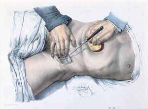 Podvazování tepny, deska z „Traite Complet de l