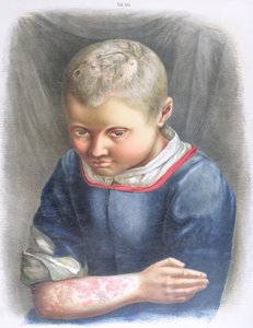 Favus, z knihy Daniela Corneliuse Danielssena (1815-94) 1892 od Norwegian School