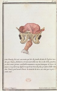 Průřezový diagram dítěte vytaženého z lůna za paži, z knihy Madame Angelique Le Boursier du Coudray (1714-94), kterou vyryl J. Robert, 1783 od P. Chapparre