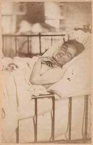 Hysterická epilepsie, permanentní kontrakce, deska XXVIII z knihy "Iconographie Photographique de La Salpetriere" od Bourneville et P. Regnard, Paříž, 1876 (albumenový tisk)