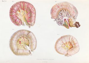 Vnější povrch střev infikovaných cholerou, z Anatomie Pathologique du Cholera Morbus, od Nikolaje Ivanoviče Pirogova (1810-81), publikováno v Petrohradě, 1849 od Russian School