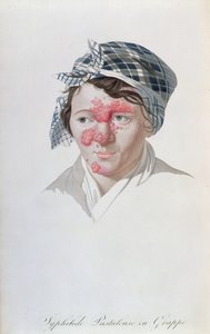 Syphilic cluster pustules, z knihy barona Jean Louis Alibert (1768-1837) 1838