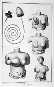 Operace prsu, 1751-1777 od Unbekannt