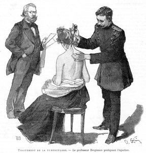 Profesor Bergmann injekčně podával pacientovi s tuberkulózou, 1891 od Unbekannt