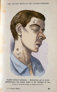 Příznaky terciární fáze syfilis, c19. století od Unbekannt