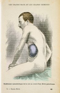 Typická zvětšená slezina pacienta s malárií, c1890 od Unbekannt