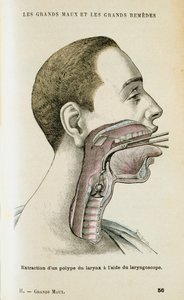 Použití laryngoskopu k odstranění polypu z krku, c1890 od Unbekannt