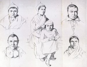 Úvahy o příčinách endemického kretinismu od Morela. od Unknown artist