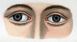 Strabismus divergentní. „Nový přírodní lék“ od F.E. Bilze. od Unknown artist