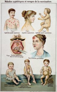 Deska ilustrující různé koleje syfilitických nemocí a nebezpečí očkování - v přírodní medicíně Bilz koncem 19. století. od Unknown artist